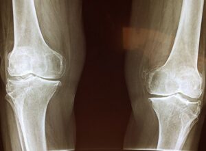 How to Prevent and Reduce the Risk of Bone Spurs